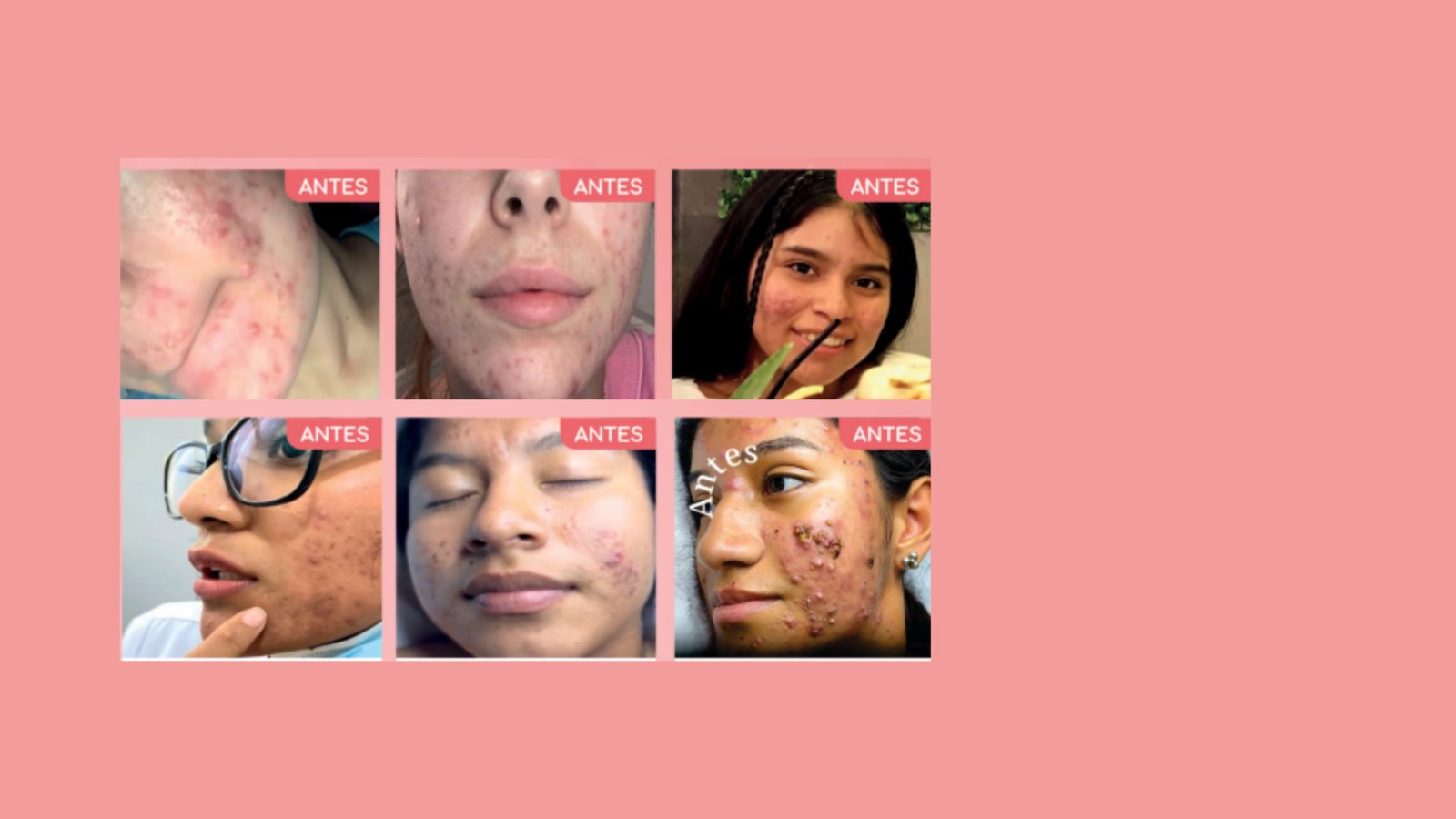 Antes del tratamiento facial